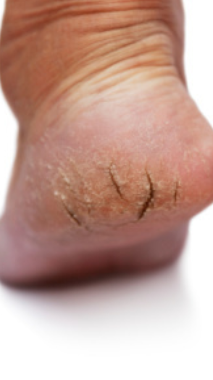 Dr. Scholl's Severe Cracked Heel Balm 70g | Lazada PH