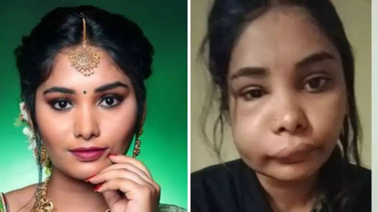 Kannada actress Swathi Sathish looks unrecognisable after root canal  surgery goes wrong