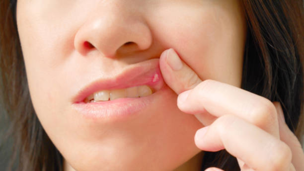 Everything You Need to Know About Mouth Ulcers: Causes, Remedies, and Tips for Prevention