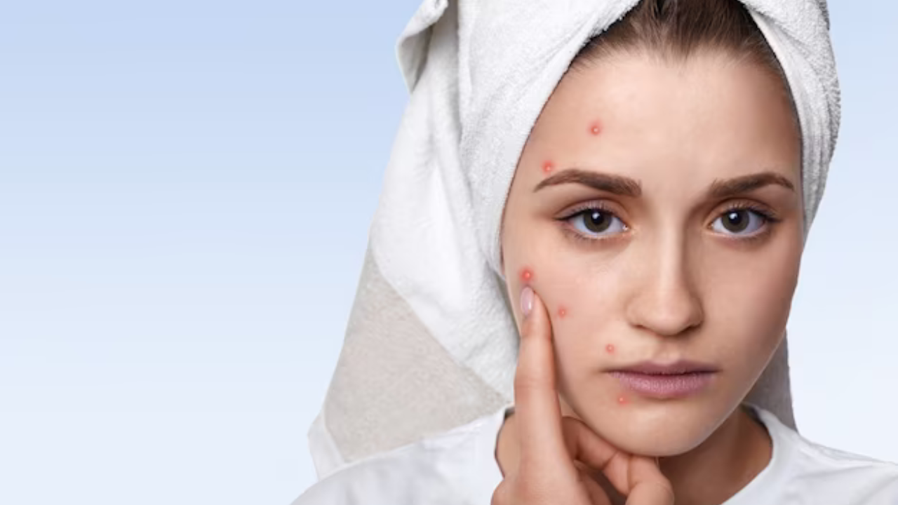 how-to-get-rid-of-pimples-on-face-expert-suggests-these-ayurvedic