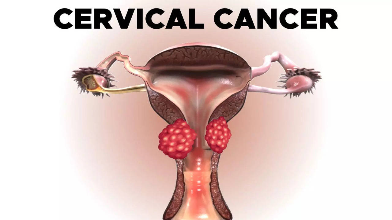 Understanding Cervical Cancer: Its Warning Signs And Early Detection