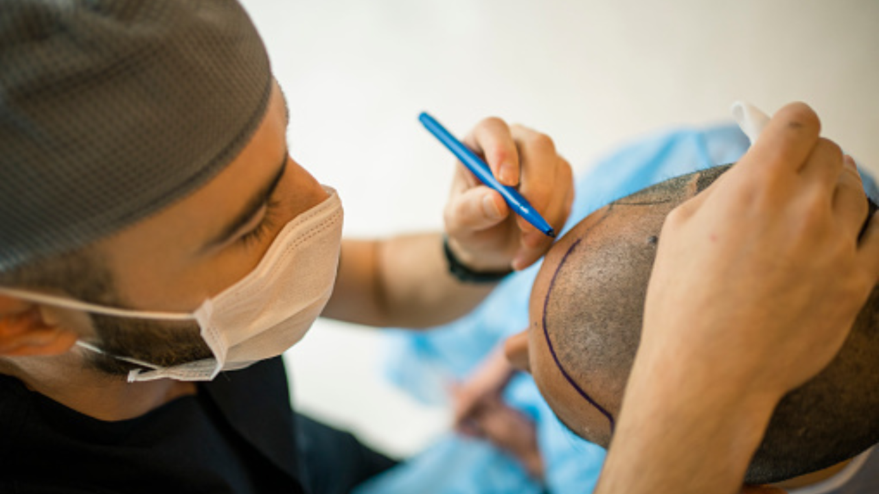 Dermatologist reveals things to keep in mind before going for a hair transplant