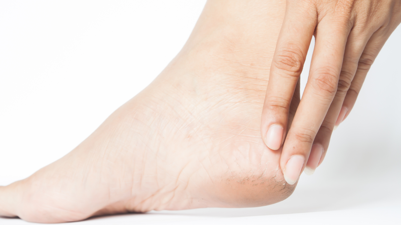 7 Ways to Soothe Cracked Heels with Simple Kitchen Ingredients